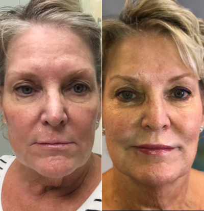 Dermal Fillers before and after photo