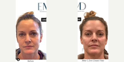 Dermal Fillers before and after photo