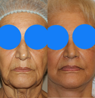 Rhinoplasty before and after photo