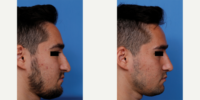 Septoplasty before and after photo