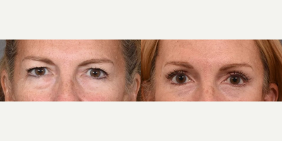 Eyelid Surgery before and after photo