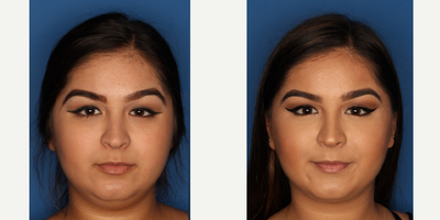 Kybella before and after photo
