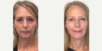 Liquid Facelift before and after photo