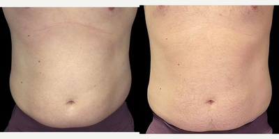 truSculpt before and after photo