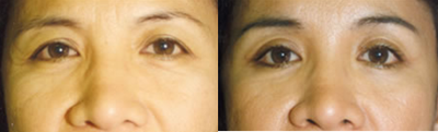 Eyelid Surgery before and after photo