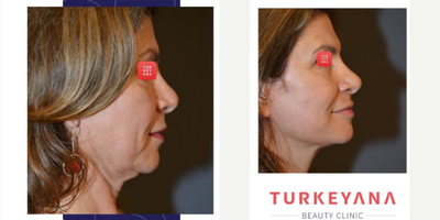 Facelift before and after photo