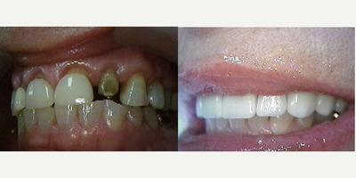 Porcelain Veneers before and after photo