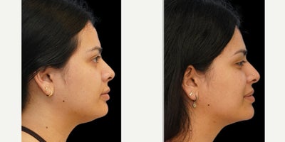 Chin Liposuction before and after photo