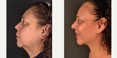 Facelift before and after photo