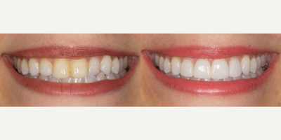 Invisalign before and after photo