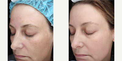 Laser Resurfacing before and after photo