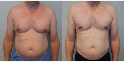 Liposuction before and after photo