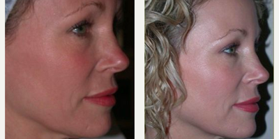 Thermage before and after photo