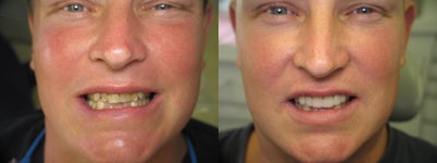Dental Crown before and after photo