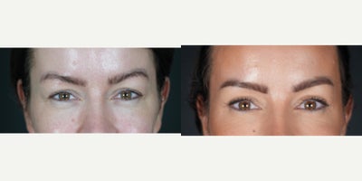 Eyelid Surgery before and after photo