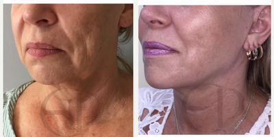 Facelift before and after photo