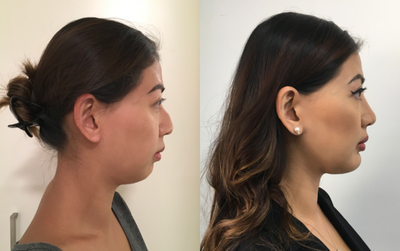 Genioplasty before and after photo