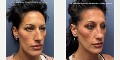 Rhinoplasty before and after photo