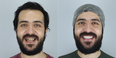Dental Crown before and after photo