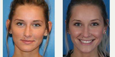 Ear Surgery before and after photo