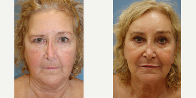 Facelift before and after photo