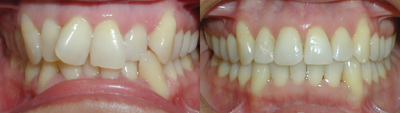 Invisalign before and after photo
