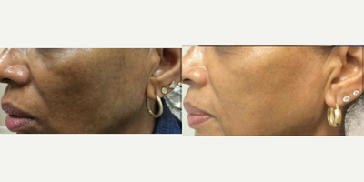 Laser Resurfacing before and after photo