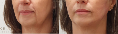 Nonsurgical Facelift before and after photo