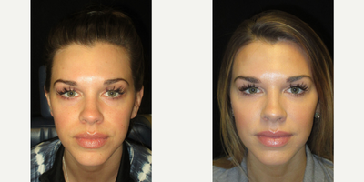 Cheek Fillers before and after photo