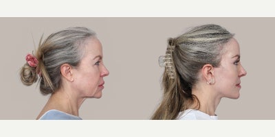 Eyelid Surgery before and after photo