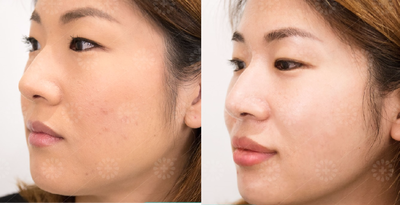 Restylane Silk before and after photo