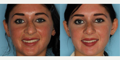Rhinoplasty before and after photo