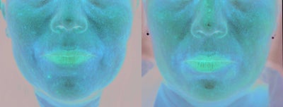 TCA Peel before and after photo
