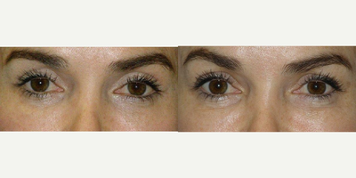 Eyelid Surgery before and after photo