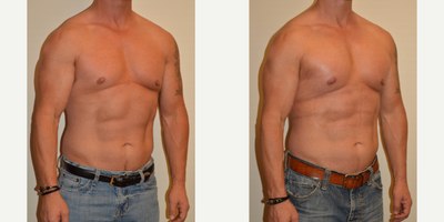 Pec Implants before and after photo