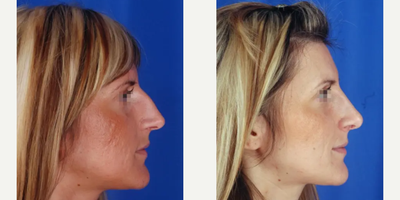 Rhinoplasty before and after photo