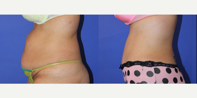 Tummy Tuck before and after photo
