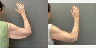 Arm Lift before and after photo