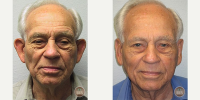 Ear Surgery before and after photo