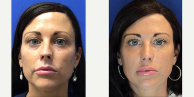 Lip Fillers before and after photo