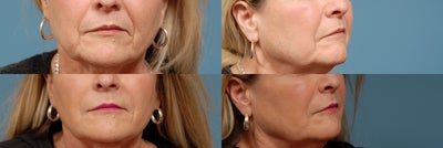Sculptra before and after photo