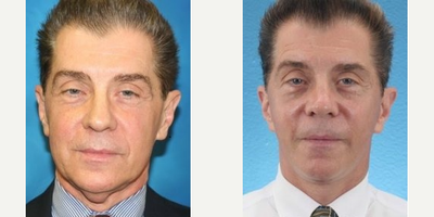 Facelift before and after photo