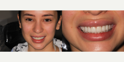 Smile Makeover before and after photo