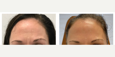 Botox before and after photo