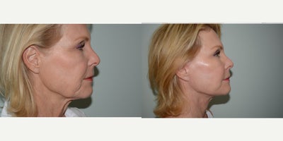 Brow Lift before and after photo