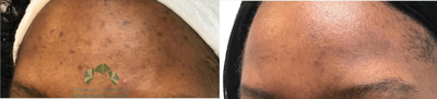 Chemical Peel before and after photo
