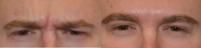 Dysport before and after photo