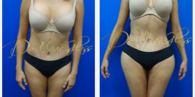 Liposuction before and after photo