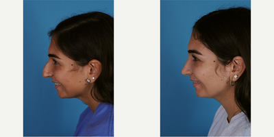 Rhinoplasty before and after photo