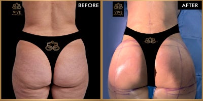Rhinoplasty before and after photo